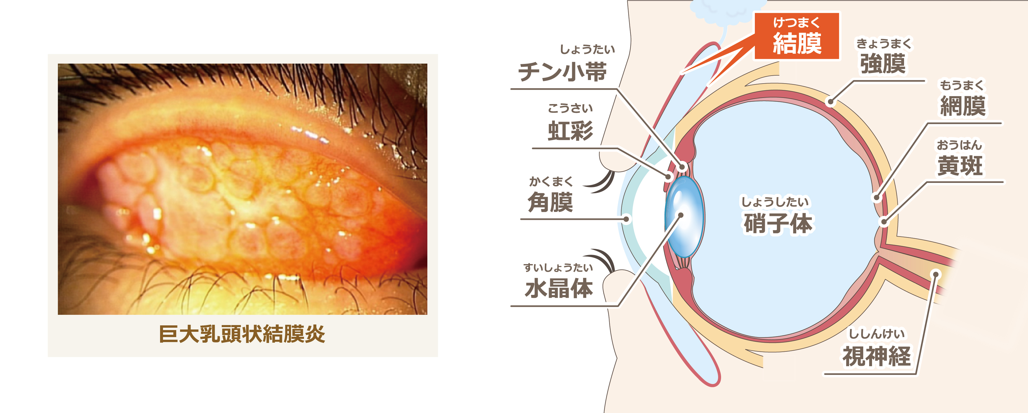 アレルギー性角結膜炎_1