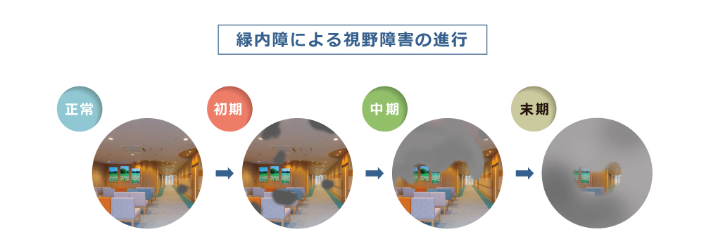 緑内障による視野障害の進行