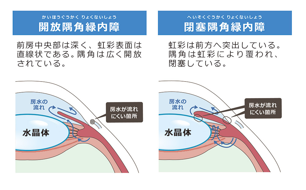 開放隅角緑内障と閉塞隅角緑内障