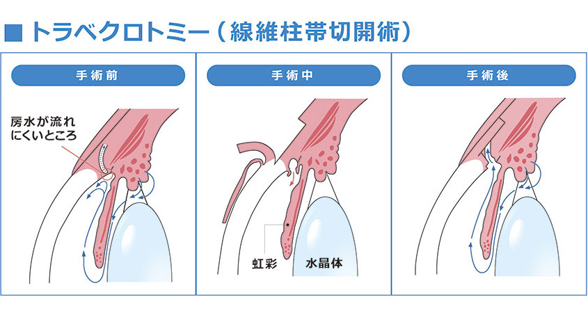 図6 トラべクトロミー（線維柱帯切開術）