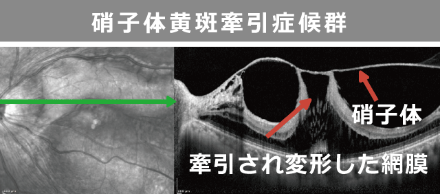 硝子体黄斑牽引症候群