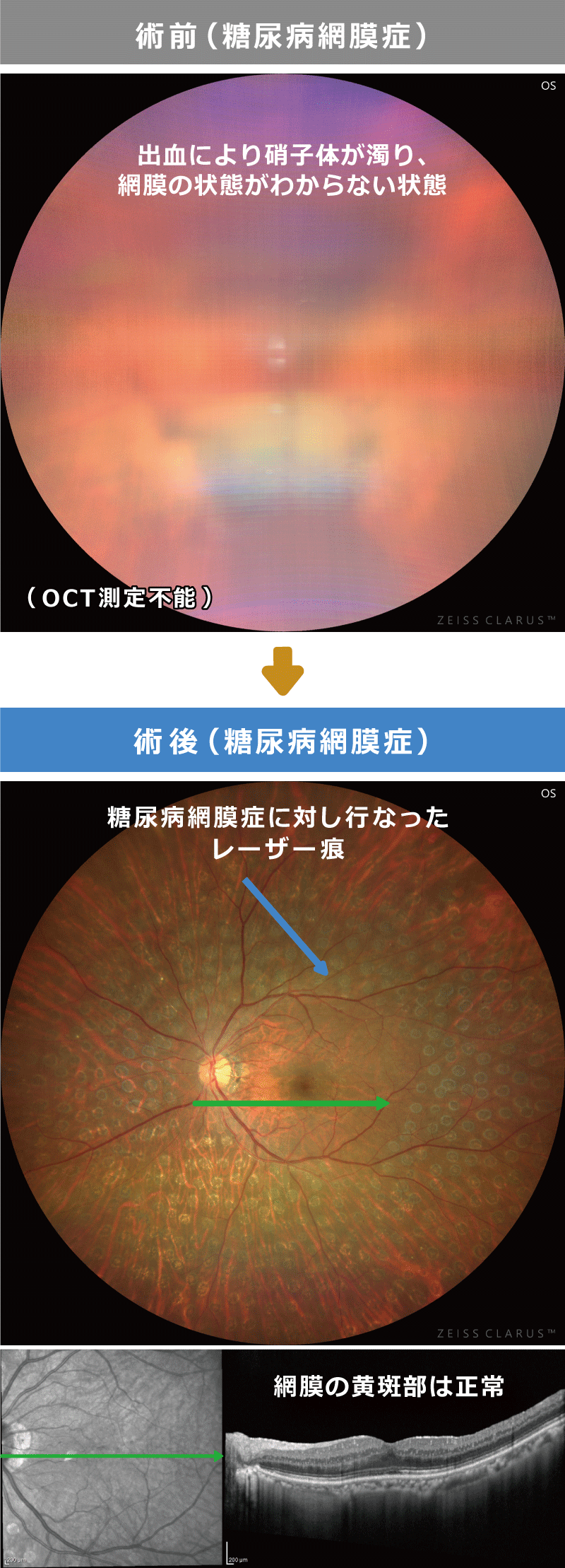 硝子体出血混濁 術前術後