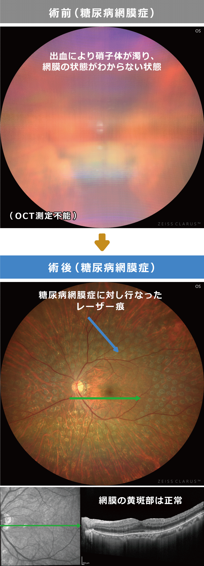 硝子体出血混濁　術前術後