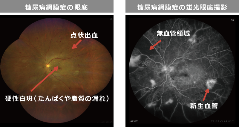 糖尿病網膜症　眼底