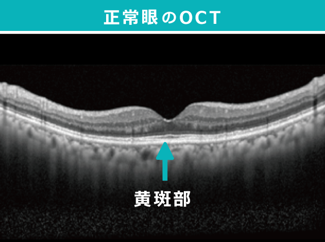 正常眼