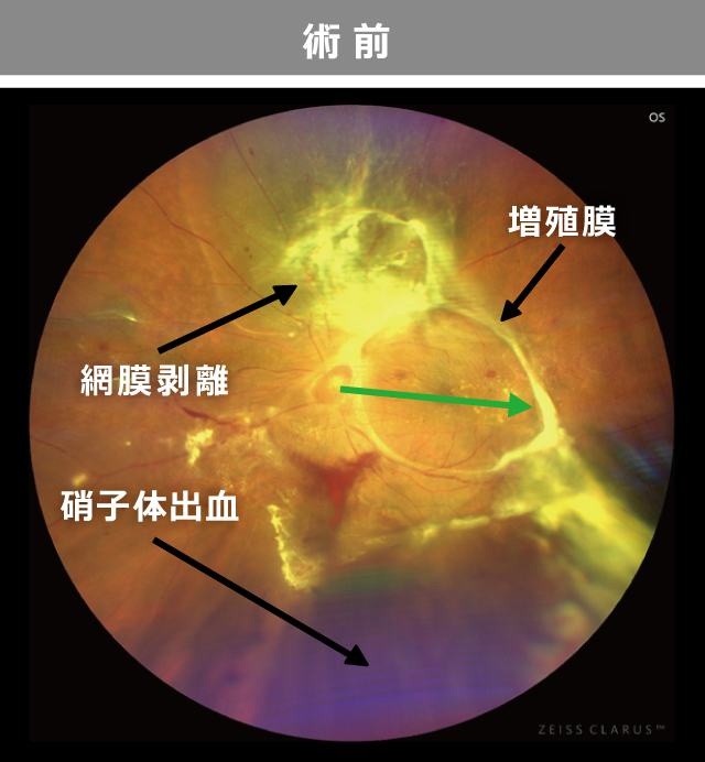 増殖糖尿病網膜症 術前