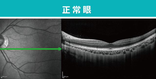 正常眼