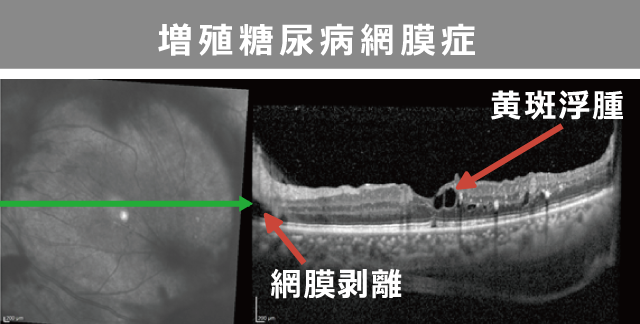 増殖糖尿病網膜症