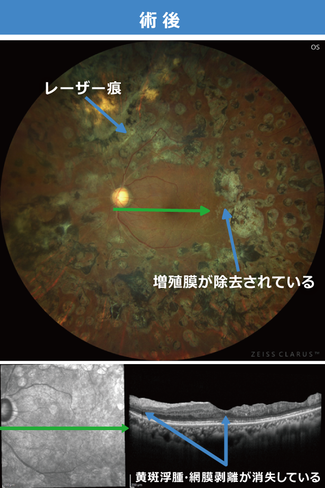 増殖糖尿病網膜症 術後