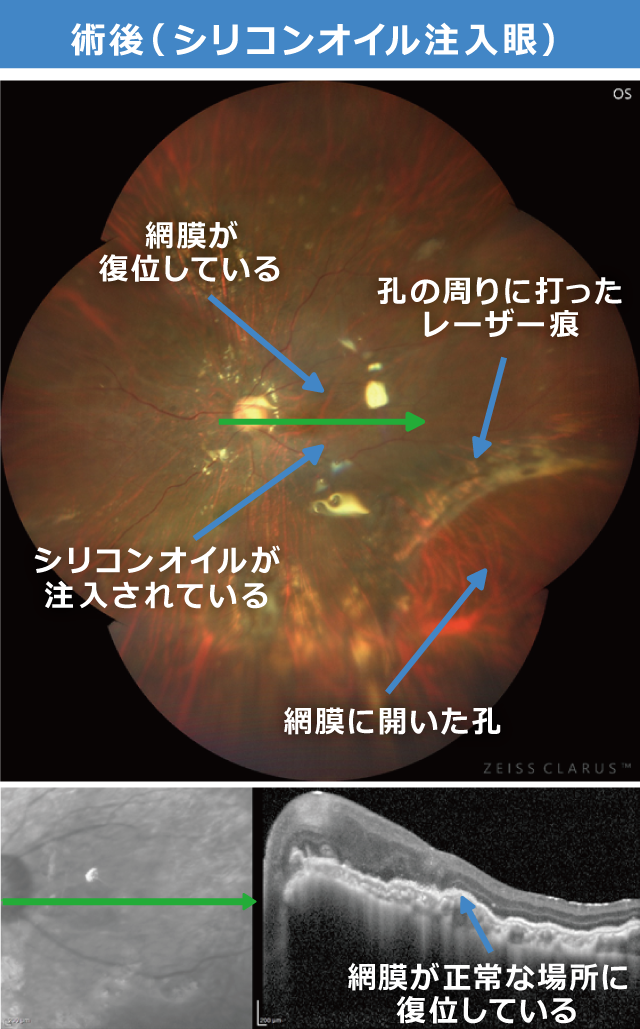 増殖硝子体網膜症 術後　シリコンオイル注入後