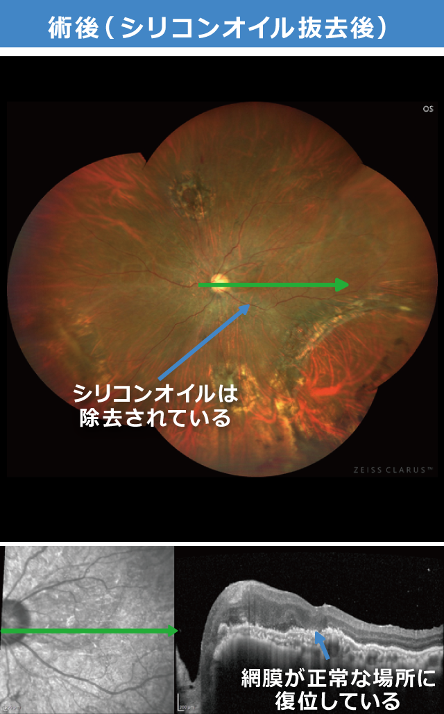 増殖硝子体網膜症 術後　シリコンオイル抜去後