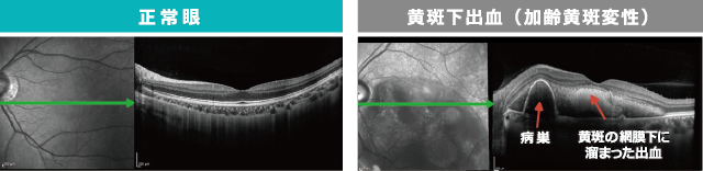 正常眼