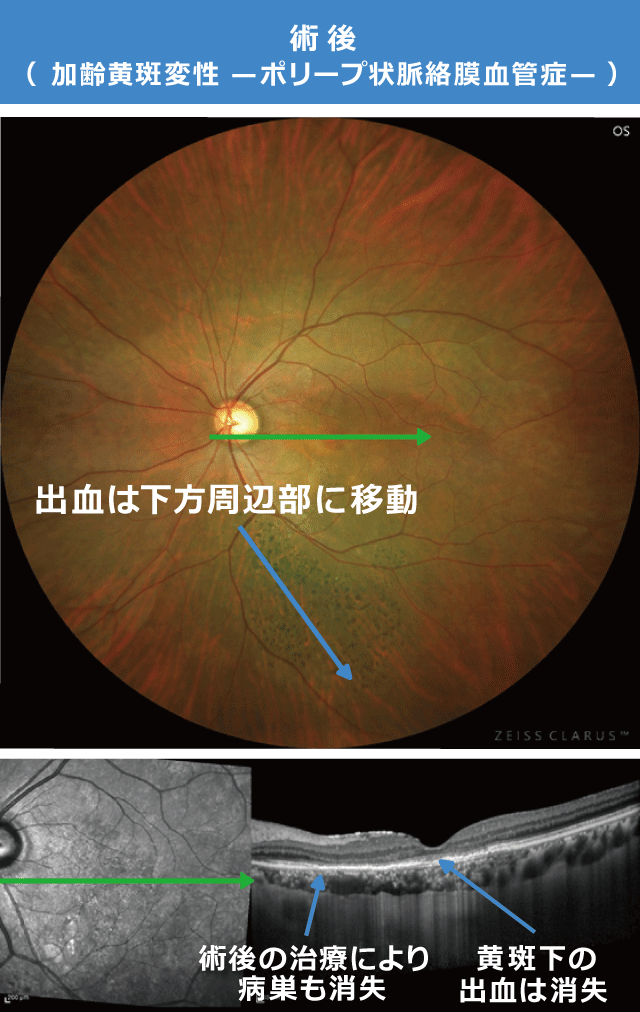 黄斑下出血 術後