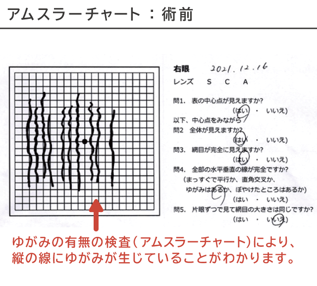 アムスラーチャート