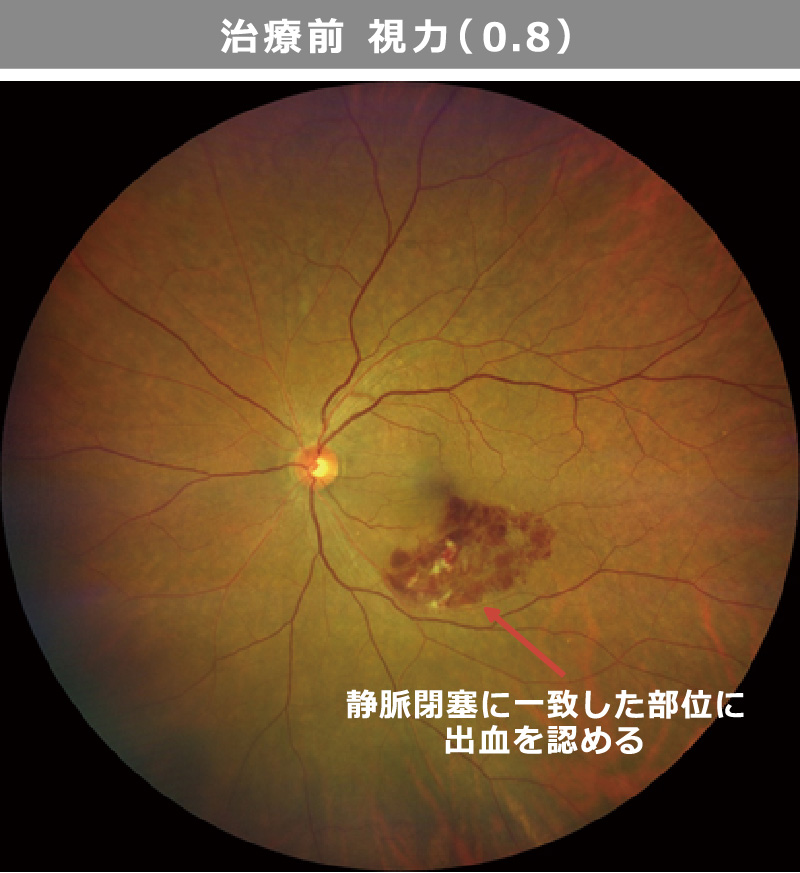 治療前：視力（0.8）