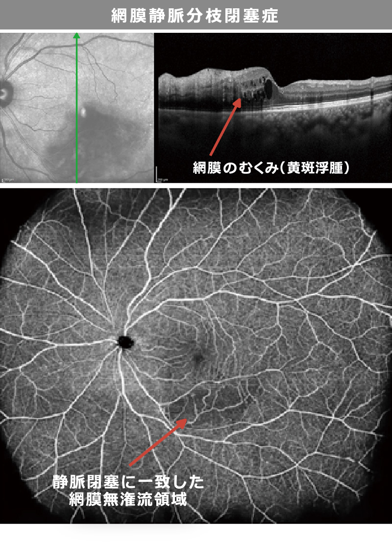 網膜静脈分岐閉塞症