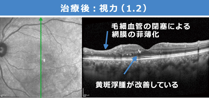 治療後：視力（1.2）