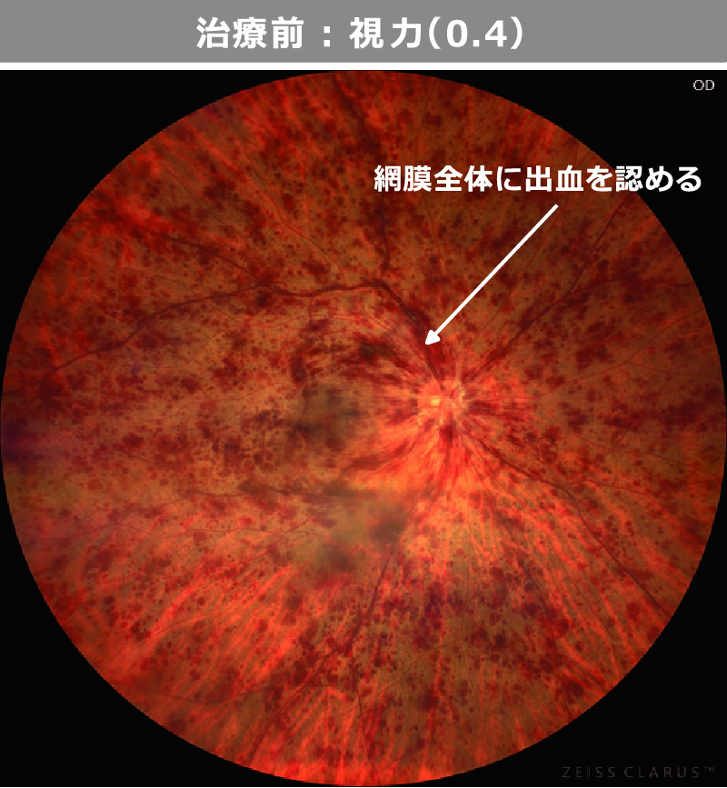 治療前：視力（0.4）
