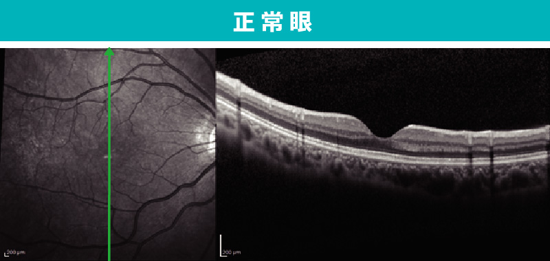 正常眼