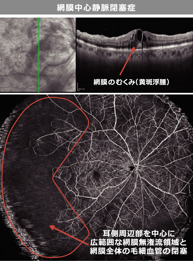 網膜中心静脈閉塞症