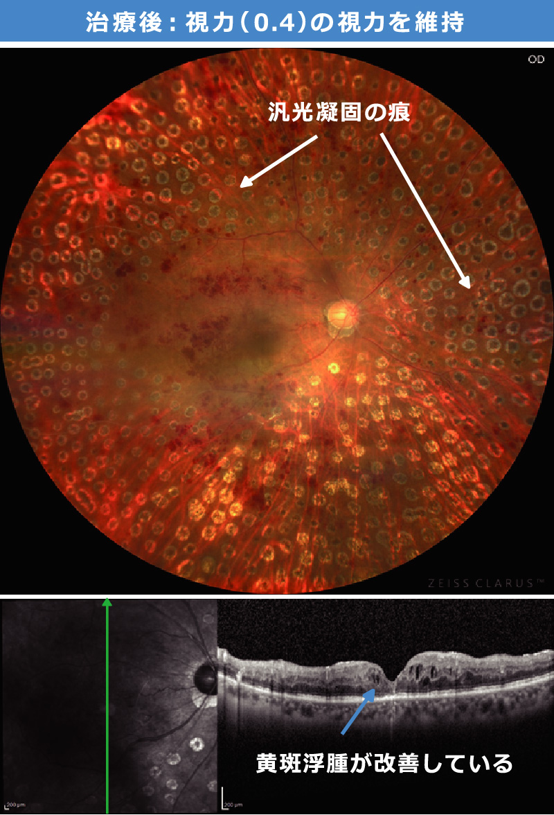 治療後：視力（0.4）