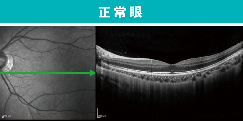 正常眼