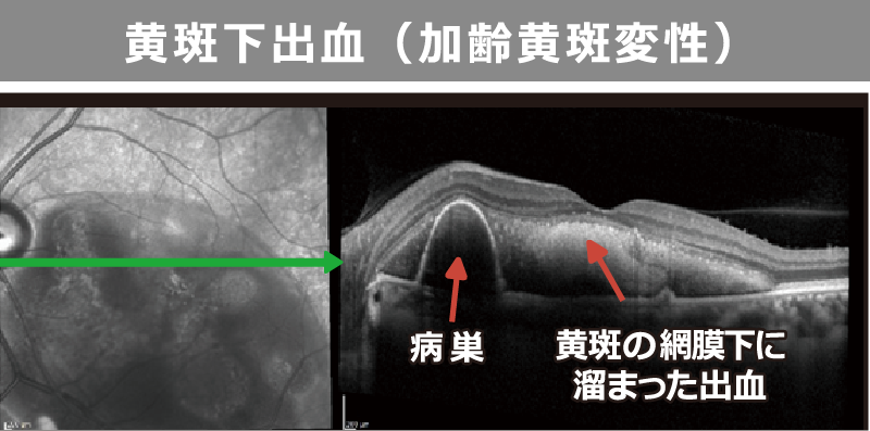 黄斑下出血 加齢黄斑変性