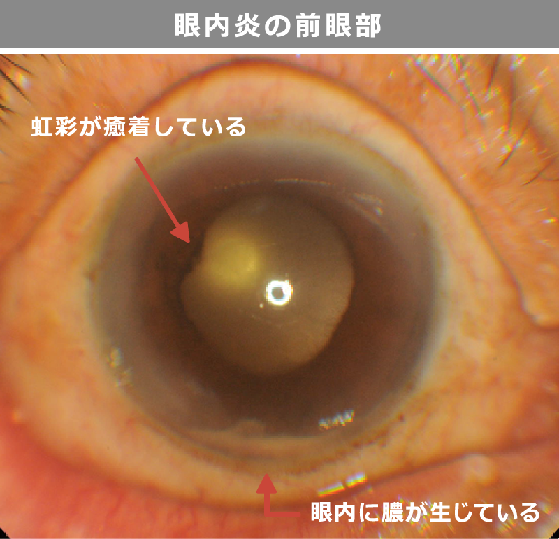 感染性眼内炎：前眼部