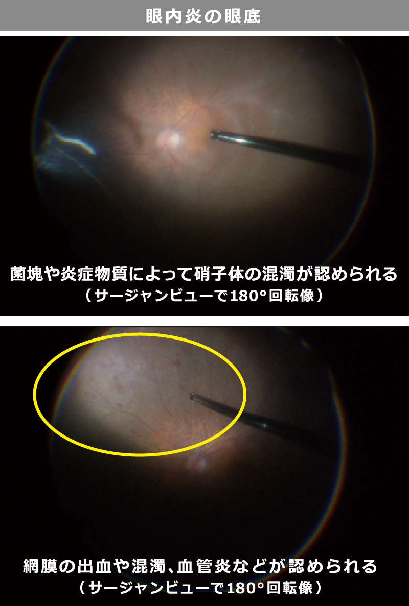 感染性眼内炎:眼底