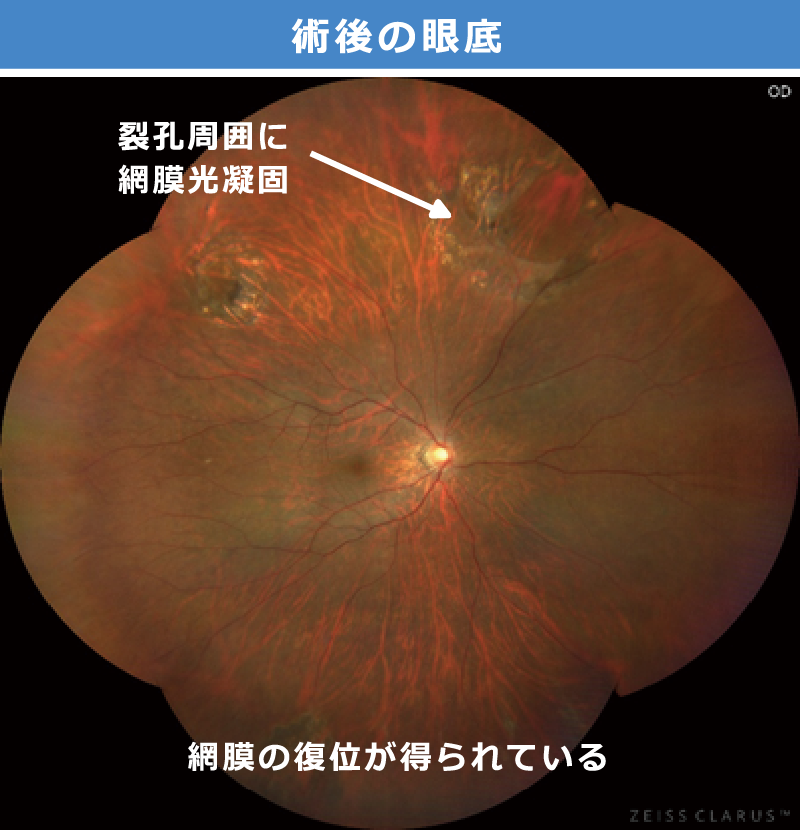 裂孔原性網膜剥離