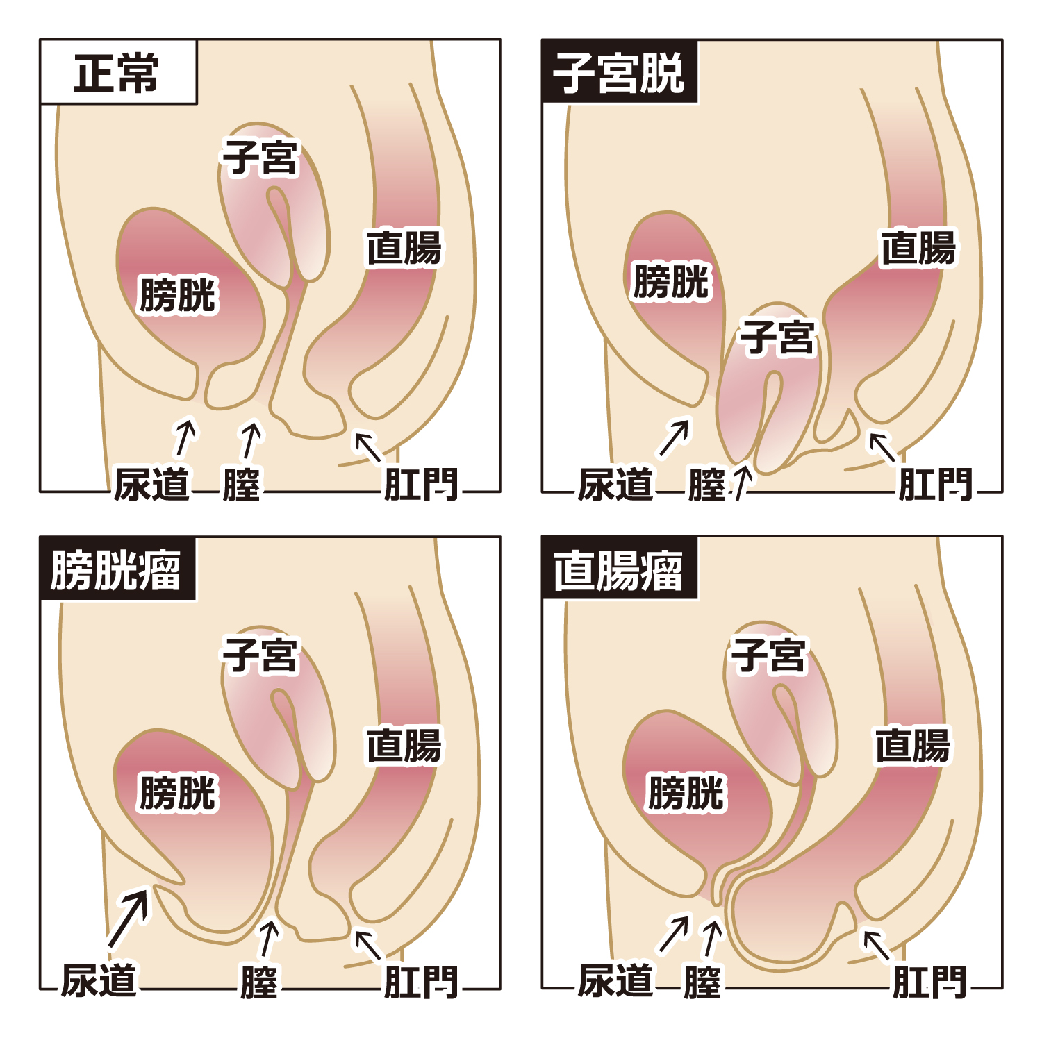 骨盤臓器脱の種類