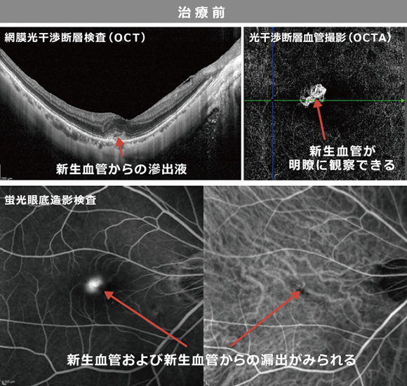 近視性黄斑部新生血管