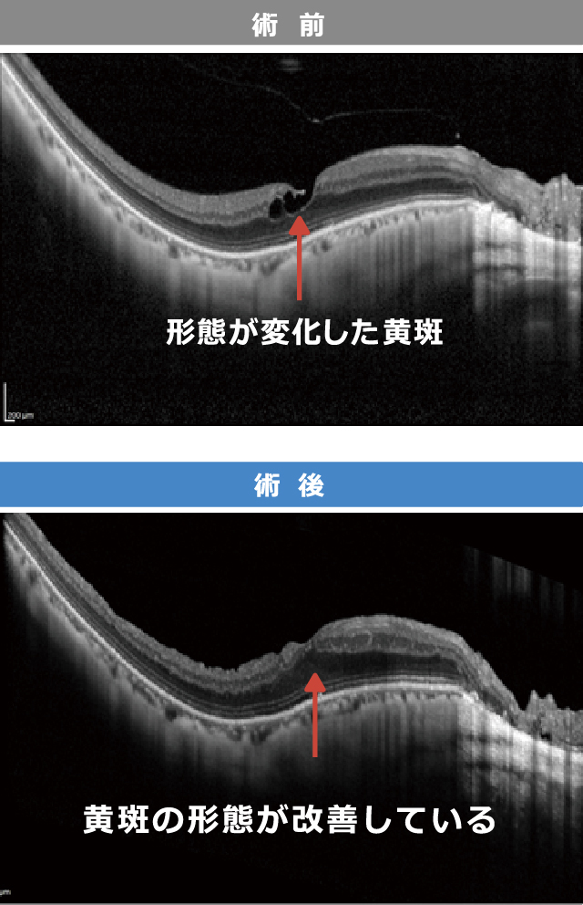 病的近視