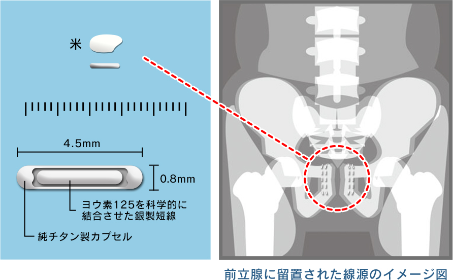 小線源療法