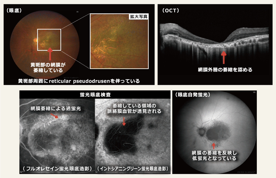 萎縮型加齢黄斑変性