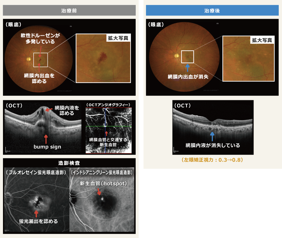 04網膜内血管腫状増殖