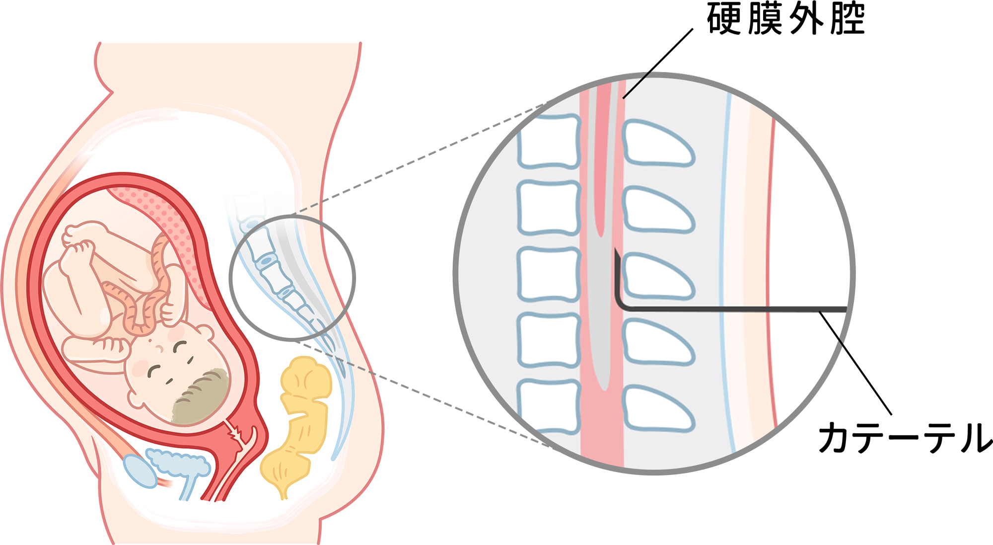 硬膜外麻酔法