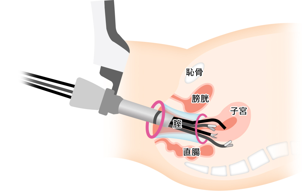 経腟的内視鏡手術_ダビンチSP