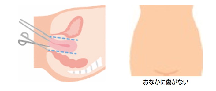 膣式＋傷