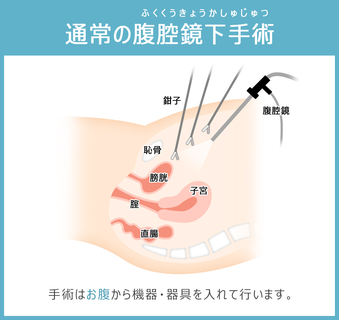 通常の腹腔鏡下手術