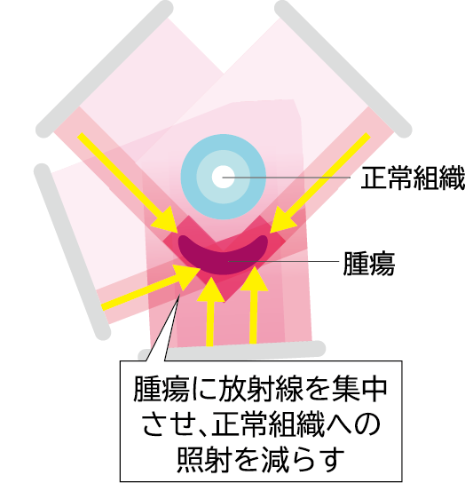IMRT照射イメージ