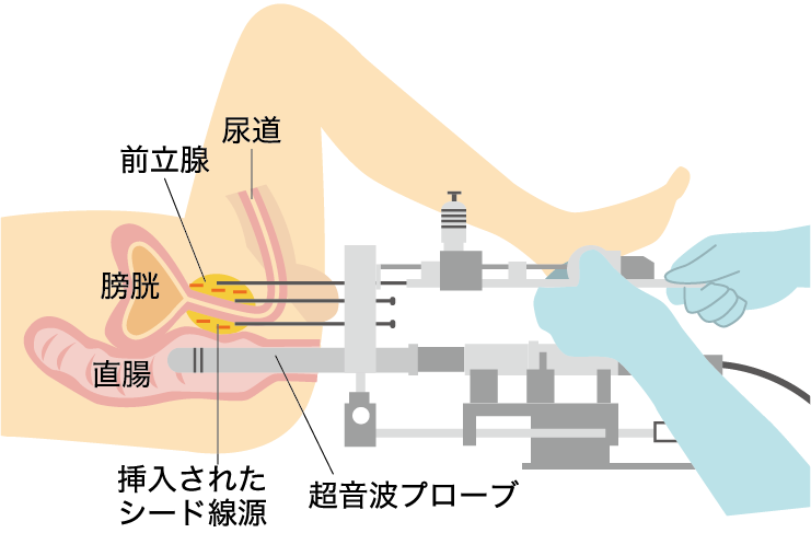 小線源手術イラスト