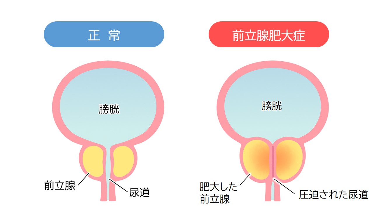前立腺肥大比較