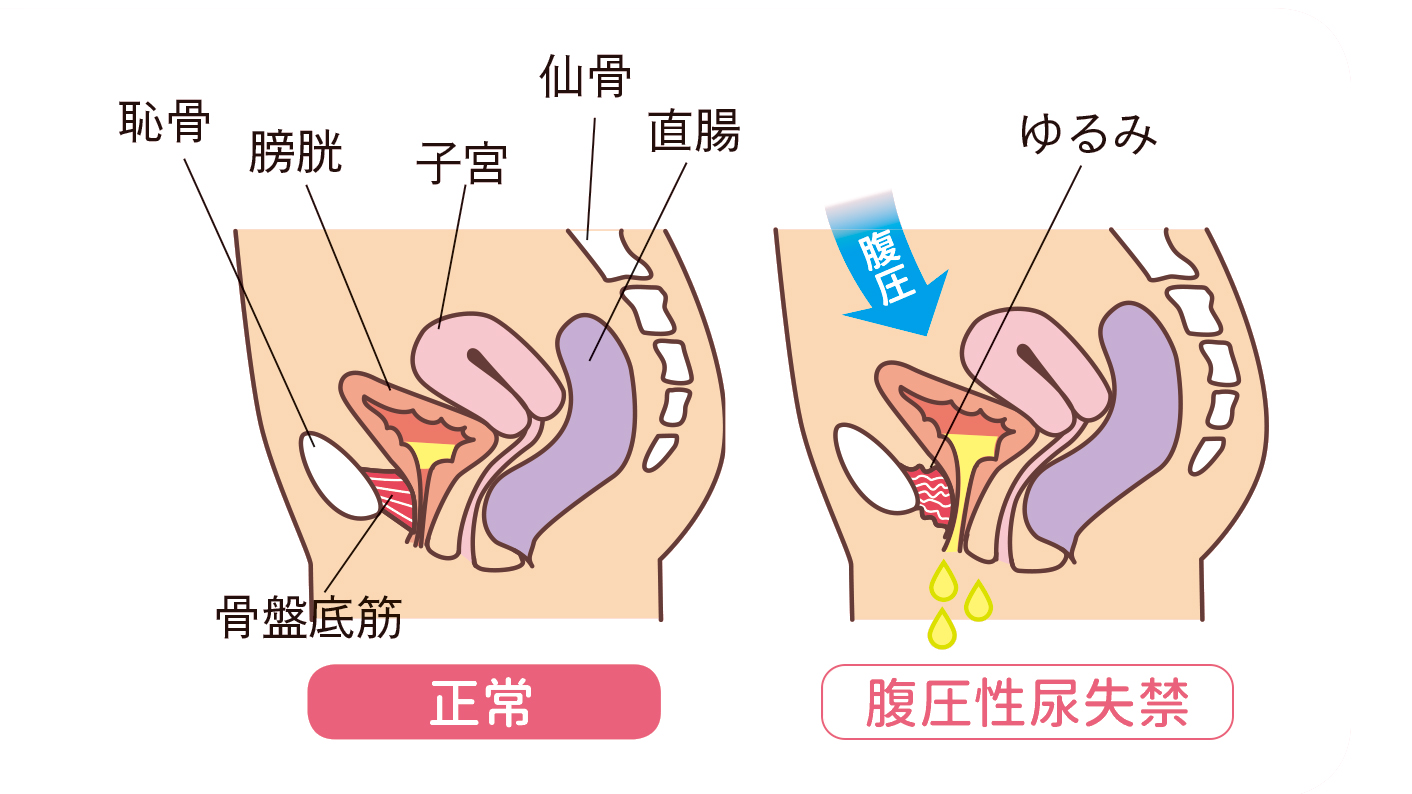 尿失禁