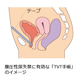 尿失禁手術イメージ_TVT手術
