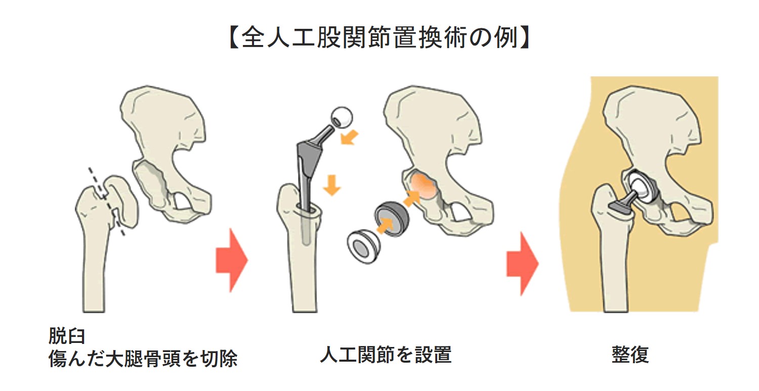 人工股関節全置換術の例