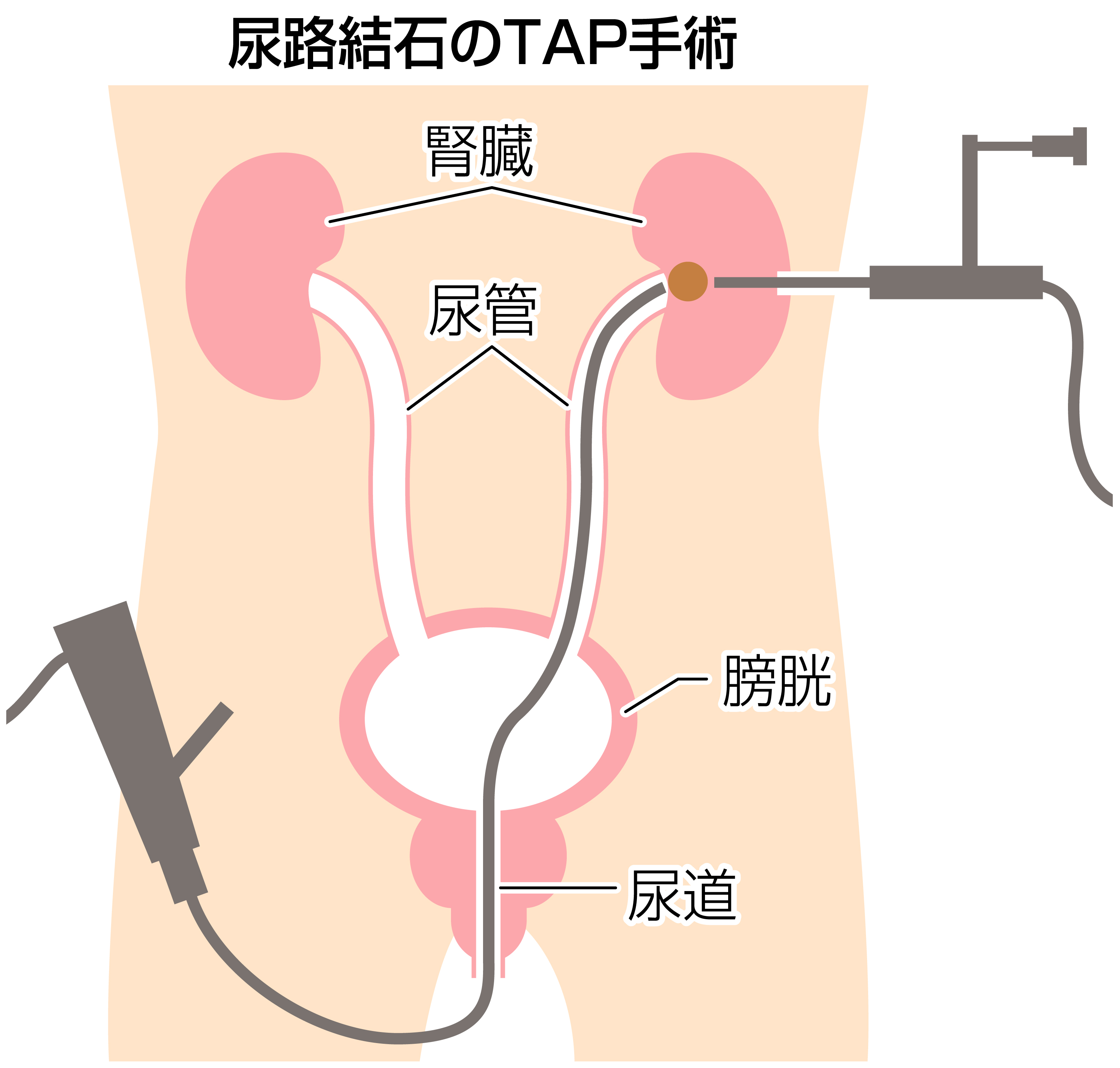 尿路結石