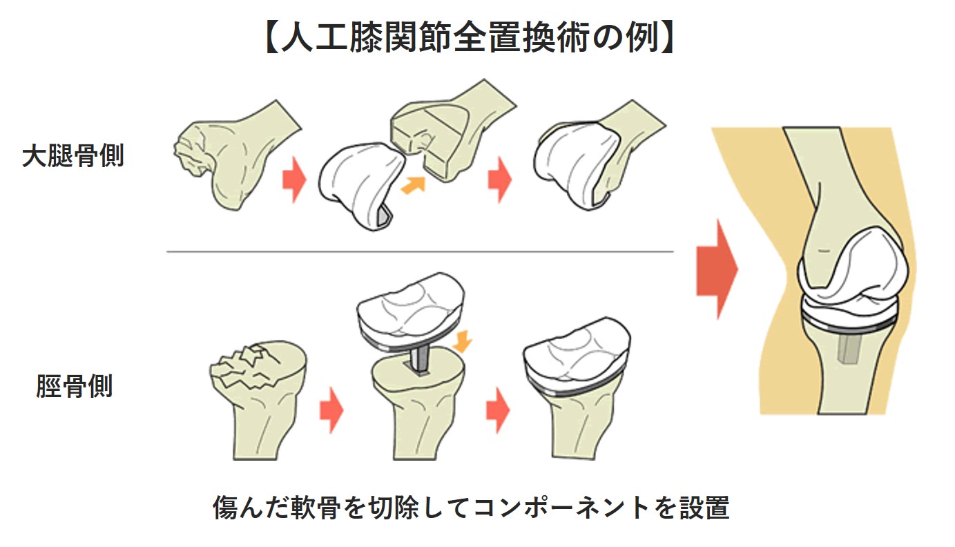 変形性膝関節症
