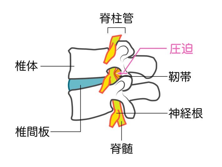 脊椎疾患　腰部脊柱管狭窄症