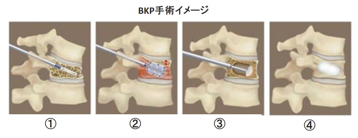脊椎疾患　腰椎圧迫骨折BKP